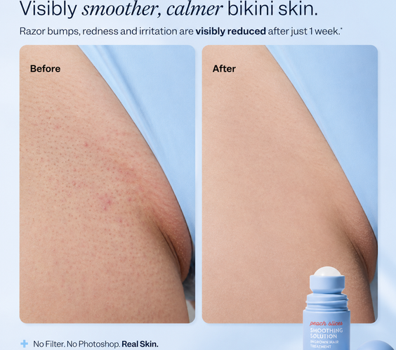 SmoothSkin Post-Shave Treatment Roller