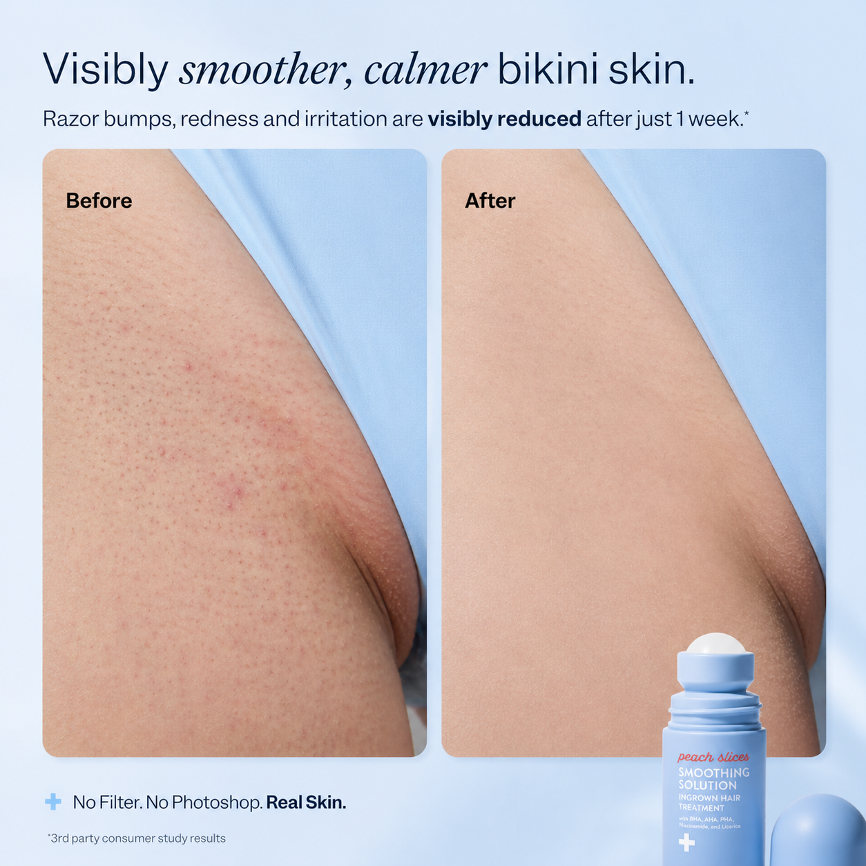 SmoothSkin Post-Shave Treatment Roller