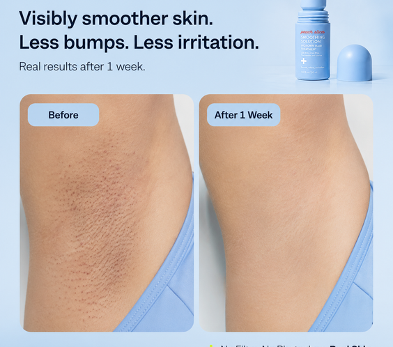 SmoothSkin Post-Shave Treatment Roller